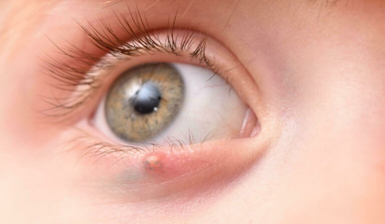 What to Do When That Small Lump on Your Eyelid Doesn’t Go Away