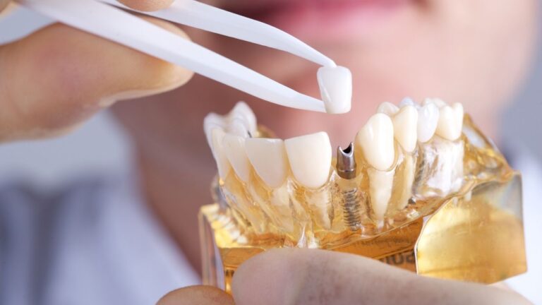 The Price Tag of Precision: How Location Affects Single Tooth Implant Costs in Australia